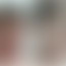 X-chromosomale retikuläre Pigmentstörung mit systemischen Manifestationen: &nbsp;hoher Haaransatz...