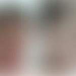 X-chromosomale retikuläre Pigmentstörung mit systemischen Manifestationen: &nbsp;hoher Haaransatz...