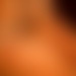 Pustulosis palmaris et plantaris: Akut aufgetretene, disseminierte, 0,2-0,4 cm große, glatte gelb...
