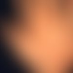 Arzneimittelexanthem mit Blasenbildung an der Handfläche
