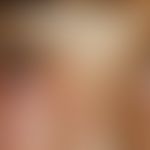 Angioödem: Einseitige Schwellung des Augenunterlides
