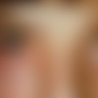Angioödem: Einseitige Schwellung des Augenunterlides
