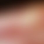 Handdermatitis, chronische: Tiefe Rhagaden in der Leistenhaut bei chronischem Handekzem
