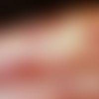 Handdermatitis, chronische: Tiefe Rhagaden in der Leistenhaut bei chronischem Handekzem
