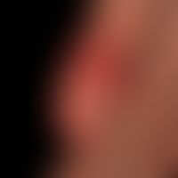 Acrodermatitis continua suppurativa:&nbsp;abgeschwächtes Krankheitsbild. Seit 1 Jahr rezdivierend...