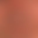 Adenoma sebaceum: dissemnierte, dicht stehende, chronisch stationäre (keine dynamische&nbsp;Entwi...