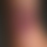 Aktinomykose: flächenhafte, wenig schmerzende&nbsp;Induration des Unterarms.
