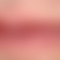 Cheilitis actinica chronica: gleichmäßige, schleierartige Leukoplakie von Ober-und Unterlippe.

&...