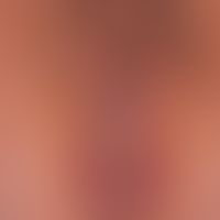 Differenzialdiagnose "anale Dermatitis"

Diagnose:&nbsp;Lichen sclerosus et atrophicus.&nbsp; Chr...
