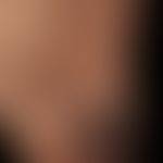 Angiokeratoma circumscriptum: seit Geburt bestehende, lokalisierte, vaskuläre Malformation mit ei...