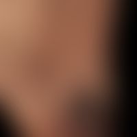 Angiokeratoma circumscriptum: seit Geburt bestehende, lokalisierte, vaskuläre Malformation mit ei...