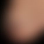 Angiokeratoma circumscriptum: seit Geburt bestehende, lokalisierte, vaskuläre Malformation mit ei...