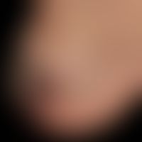Angiokeratoma circumscriptum: seit Geburt bestehende, lokalisierte, vaskuläre Malformation mit ei...