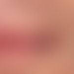 Angiom seniles der Lippen: sog. Lippenrandangiom. Harmloser, bläulicher, weicher, exprimierbarer ...