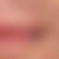 Angiom seniles der Lippen: sog. Lippenrandangiom. Harmloser, bläulicher, weicher, exprimierbarer ...