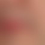 Angiom seniles der Lippen: sog. Lippenrandangiom: Zustand nach OP&nbsp;
