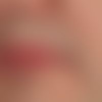 Angiom seniles der Lippen: sog. Lippenrandangiom: Zustand nach OP&nbsp;

