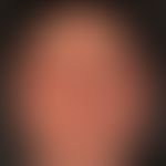 Differenzialdiagnose Angioödem: Akute txoische Kontaktdermatitis der Kopfhaut (nach Haarfärbung) ...