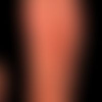 Arthritis urica:&nbsp;residuale, noch druckempfindliche Rötung und Schwellung über dem rechten Gr...