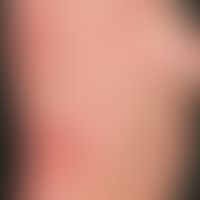 Arzneimittelexanthem urtikariell: seit&nbsp;wenigen Tagen bestehendes (jetzt steady state) urtika...