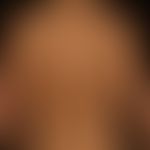Differenzialdiagnose Erythema dyschromicum perstans

Diagnose: Lichenoides Arzneimittelexanthem n...