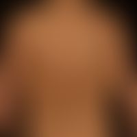 Differenzialdiagnose Erythema dyschromicum perstans

Diagnose: Lichenoides Arzneimittelexanthem n...