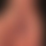 Differenzialdiagnose: Handdermatitis chronische

Diagnose: fixe Arzneimittelreaktion. Hier residu...