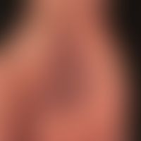 Differenzialdiagnose: Handdermatitis chronische

Diagnose: fixe Arzneimittelreaktion. Hier residu...