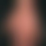 Differenzialdiagnose: Handdermatitis chronische

Diagnose: atopische Handdermatitis. Hinweise: vo...