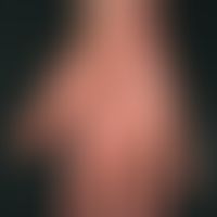 Differenzialdiagnose: Handdermatitis chronische

Diagnose: atopische Handdermatitis. Hinweise: vo...