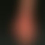 Differenzialdiagnose: Handdermatitis chronische

Diagnose: atopische Handdermatitis. Hinweise: vo...