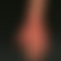 Differenzialdiagnose: Handdermatitis chronische

Diagnose: atopische Handdermatitis. Hinweise: vo...