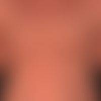 Ekzem atopisches (Übersicht): schwere, universelle&nbsp;(erythrodermische) atopische Dermatitis. ...