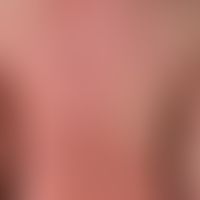 Differenzialdiagnose: Erythrodermia psoriatica

Diagnose: Erythrodermische atopische Dermatitis. ...