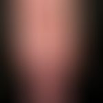 Erythrodermische atopische Dermatitis: wechselhafter Verlauf, massiver Juckeiz, zahlreiche Kratze...