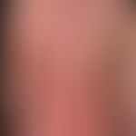 Erythrodermische atopische Dermatitis: wechselhafter Verlauf, massiver Juckeiz, zahlreiche Kratze...