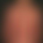 Erythrodermie:&nbsp;&nbsp;seit Jahren vorbekannte Mycosis fungoides mit allmählicher (melano-)ery...