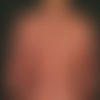 Mycosis fungoides: seit Jahren vorbekannte Mycosis fungoides. Allmähliche Entwicklung einer (Mela...