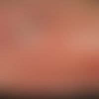 Atrophie der Haut durch langjährigen internen Gebrauch von Glukokortikoiden. Bizarre Narben durch...