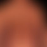 Atrophie der Haut: Krankheitsbild der Atrophodermia idiopathica et&nbsp;progressiva.
