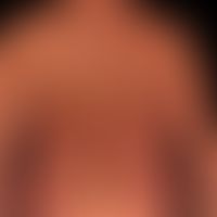 Atrophie der Haut: Krankheitsbild der Atrophodermia idiopathica et&nbsp;progressiva.
