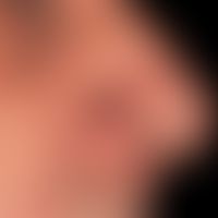 Ulkus der Haut: Basalzellkarzinom knotiges,&nbsp;seit mehreren Jahren bestehender, langsam wachse...