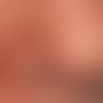 Basalzellkarzinom pigmentiertes: 0,4cm großes, symptomloses, breitbasiges Knötchen.
