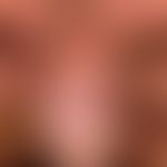 Differenzialdiagnose: Condylomata acuminata

Diagnose: Hirsuties papillaris penis (harmlose atavi...
