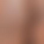 Condylomata acuminata:&nbsp;Bei dem 24-jährigen Patienten bestehen seit einigen Monaten diese, br...
