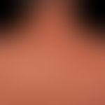 Lipoatrophie:&nbsp;druckbedingte "BH-Träger"-Lipoatrophie. Keinerlei Beschwerden. Die darüberlieg...