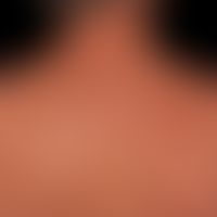 Lipoatrophie:&nbsp;druckbedingte "BH-Träger"-Lipoatrophie. Keinerlei Beschwerden. Die darüberlieg...