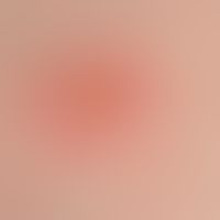 Coxsackie-Virus-Exanthem: genabeltes Bläschen mit Halo
