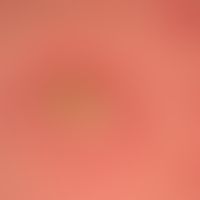 Erythema multiforme: neben einer größeren Blase eine frische, kelinere Blase (oben rechts).&nbsp;
