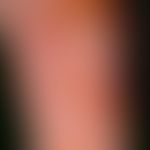 Differenzialdiagnose: Porphyria cutanea tarda&nbsp;

Diagnose: Bullöses Pemphigoid. Subepithelial...